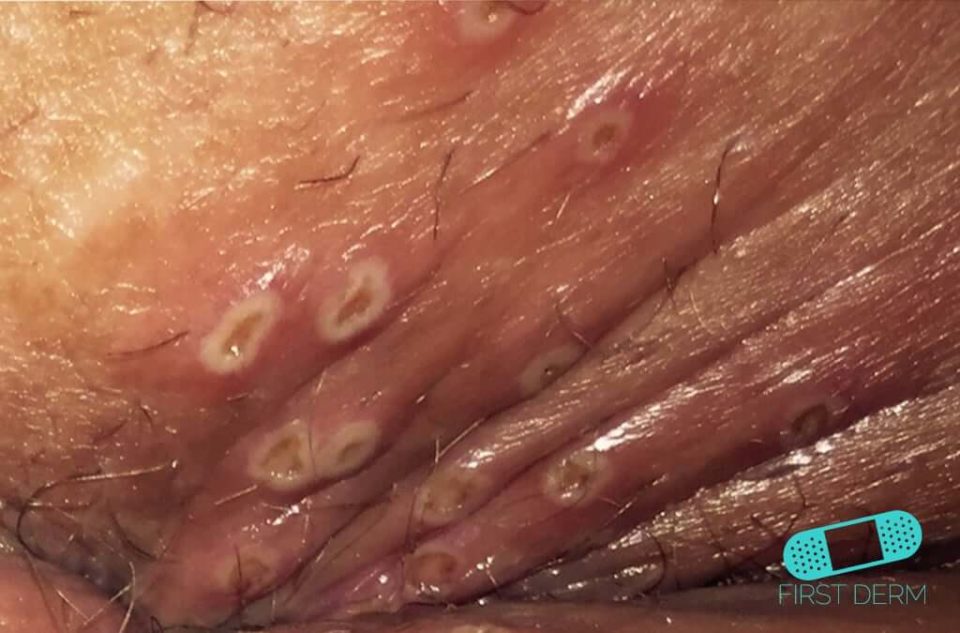Genital Herpes (13) skin [ICD-10 A60.0]