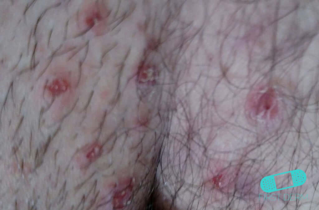 Picture of Genital Herpes visible symptoms on groin [ICD-10 A60.0]