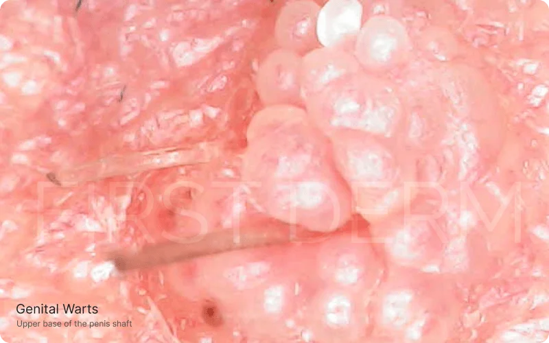 High-resolution, magnified image showcasing the distinct appearance of genital wart clusters located at the upper base of the penis shaft, providing a detailed view of this common viral condition