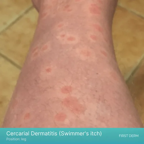 Healing swimmer’s itch rash with pigmented skin