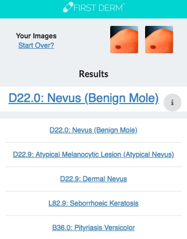 Health Chatbot Mole Nevus 2 Skin Image Search NHS