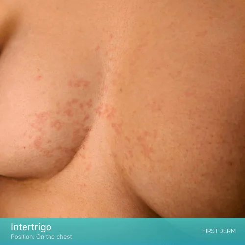 A close-up of a woman’s chest showing red patches of skin irritation caused by Intertrigo