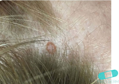 Intradermal nevus (06) scalp [ICD-10 D22.9]