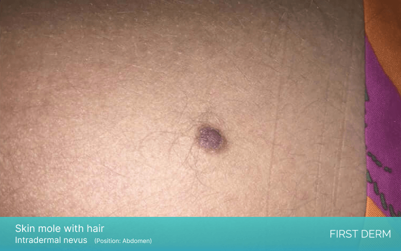 person's skin showing intradermal nevus, small dark brown moles, on the abdominal area