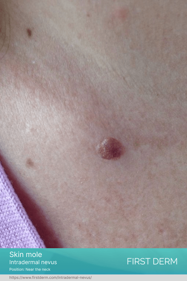 person's skin showing intradermal nevus, small dark brown moles, below the neck