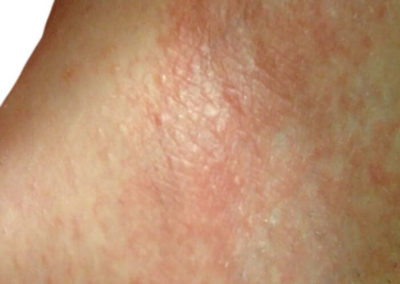 Irritationseksem (icke-allergiskt kontakteksem) (01) hud [ICD-10 L24.9]