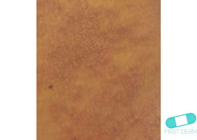 Irritative eczema (Irritant Contact Dermatitis) (04) skin [ICD-10 L24.9]