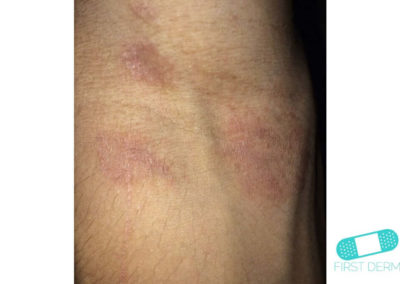 Irritative eczema (Irritant Contact Dermatitis) (03) arm [ICD-10 L24.9]