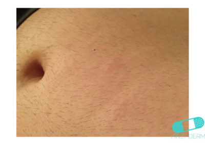 Irritative eczema (Irritant Contact Dermatitis) (01) abdomen [ICD-10 L24.9]