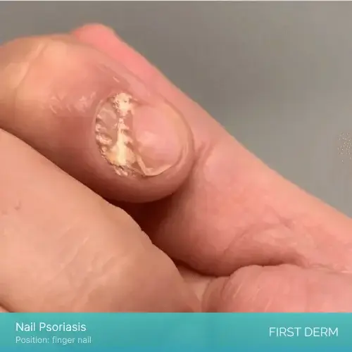 A close-up photo of a person’s hand with nail psoriasis, showing discoloration, pitting, and crumbling of the fingernails. The image illustrates the symptoms and appearance of nail psoriasis, a common condition that affects the nails of people with psoriasis