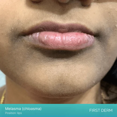 Image of a woman with brown skin tone displaying Melasma on her lips. The affected area appears as brown or gray-brown patch on the skin of the woman's lips