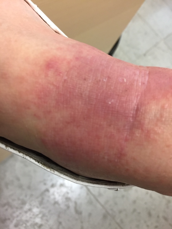 Lyme disease rash Borrelia Erythema Chronicum Migrans (ECM) left hand