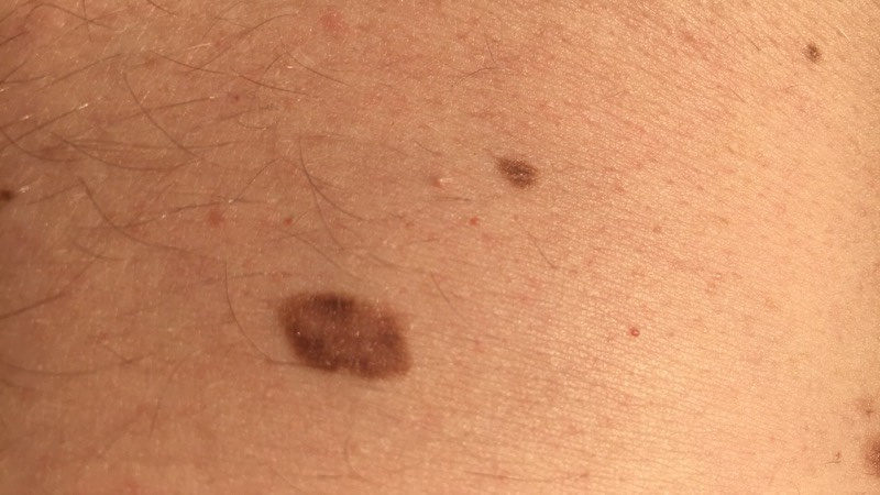 Friend malignant melanoma in situ chest 42 year old male Sweden close up