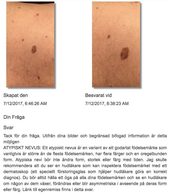 Friend malignant melanoma in situ chest 42 year old male Sweden view case