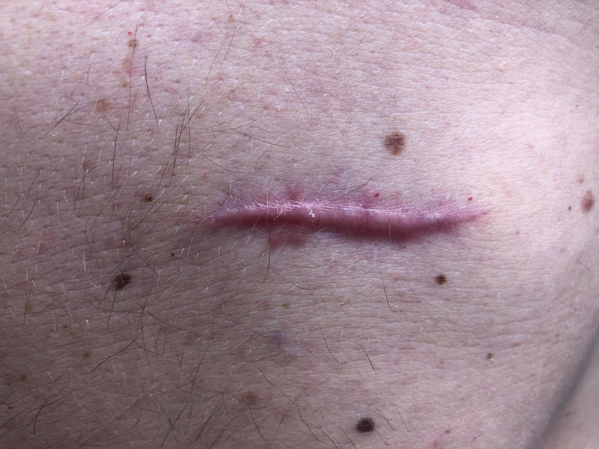 Malignant melanoma in situ chest scar tissue 42 year old male Sweden