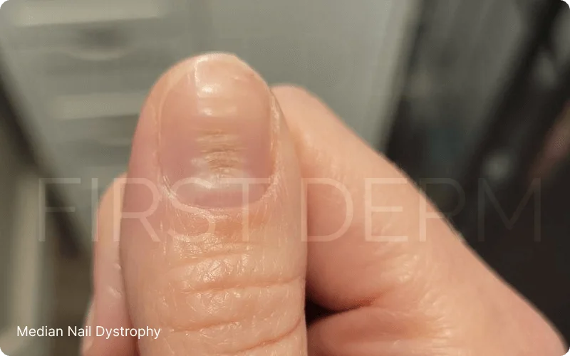 Close-up image of a thumbnail affected by Median Nail Dystrophy, showing characteristic wavy ridges and irregularities on the nail bed