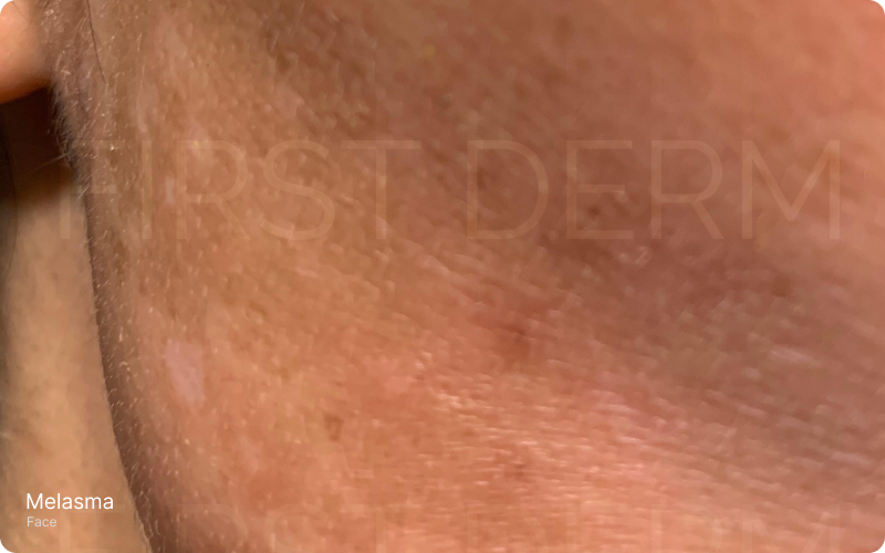 Close-up image of a face showing brown or blue-gray patches, characteristic of Melasma, a non-itchy skin condition. Particularly common in women, these benign spots often appear after sun exposure and/or hormonal influence.