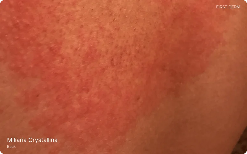 A person's back showing symptoms of Miliaria Crystallina, characterized by numerous small, clear blisters resembling beads of sweat. The condition, also known as heat rash, has caused a patchy reddish inflammation on the skin 