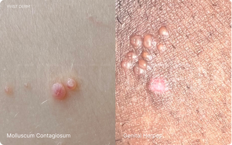 Molluscum Contagiosum vs Genital Herpes comparison: Side-by-side images. On the left, Molluscum Contagiosum is depicted as painless, pearly, dome-shaped blisters with a central dimple, and flesh-colored. On the right, Genital Herpes is shown with an itchy cluster of blisters and red, inflamed skin surrounding them. This visual provides a clear contrast between the distinct characteristics of each condition