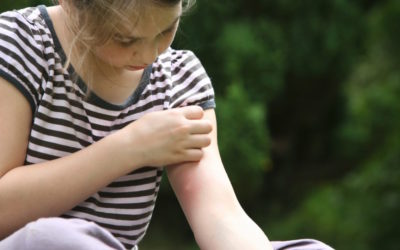8 Natural Repellents to Prevent Mosquito Bites – During Summer