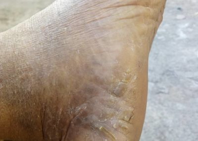 Mycosis fungoides foot C84.0