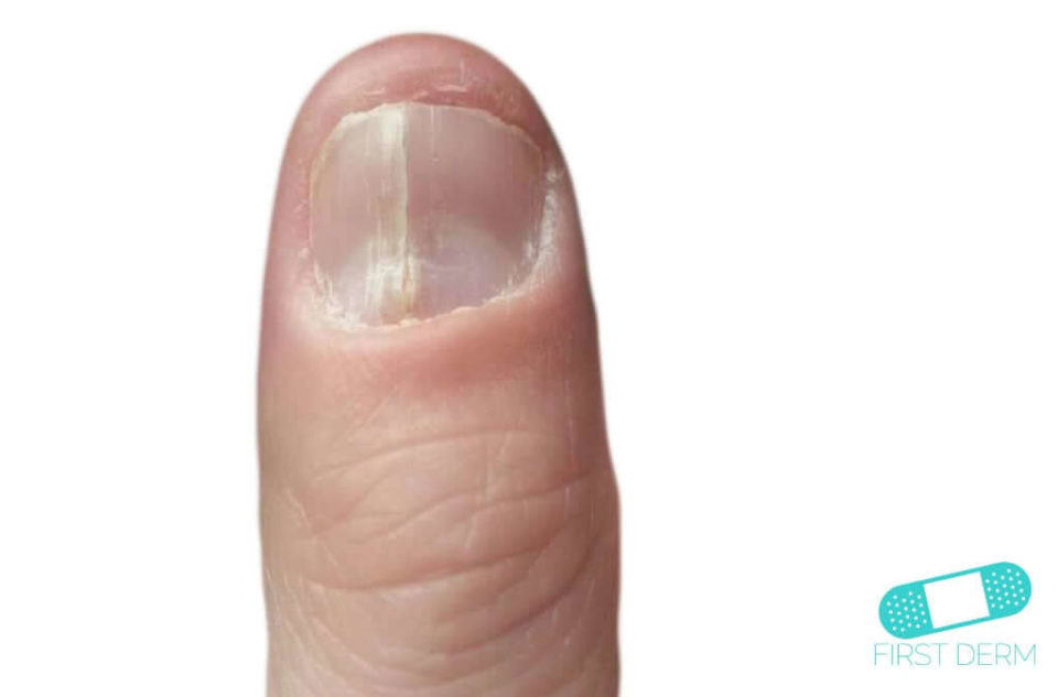 Nageldystrofi (01) finger nagel [ICD-10 L60.3]