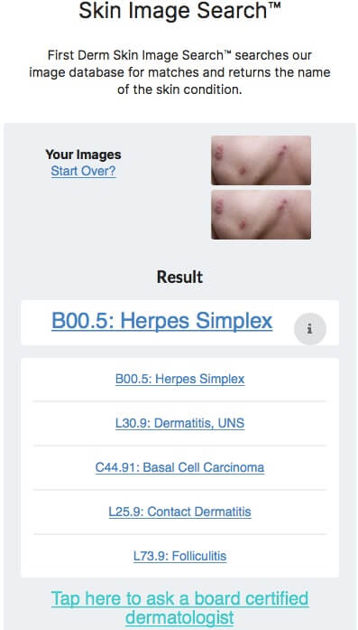 Netdoktor Herpes Simplex Brust Kind KI