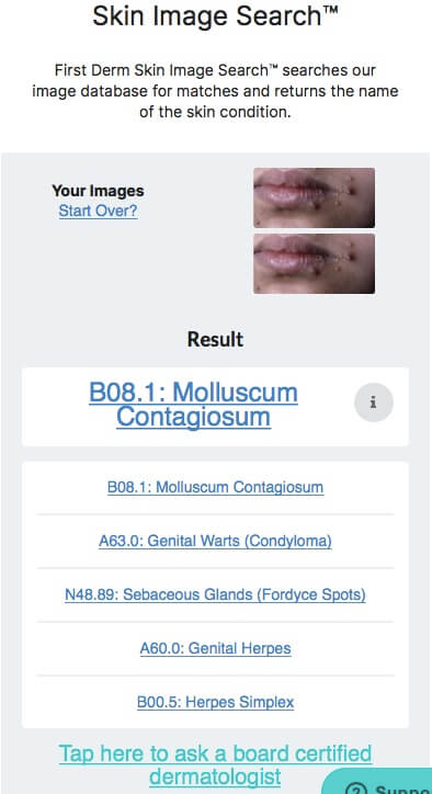 Netdoctor Molluscum Contagiosum lips child AI