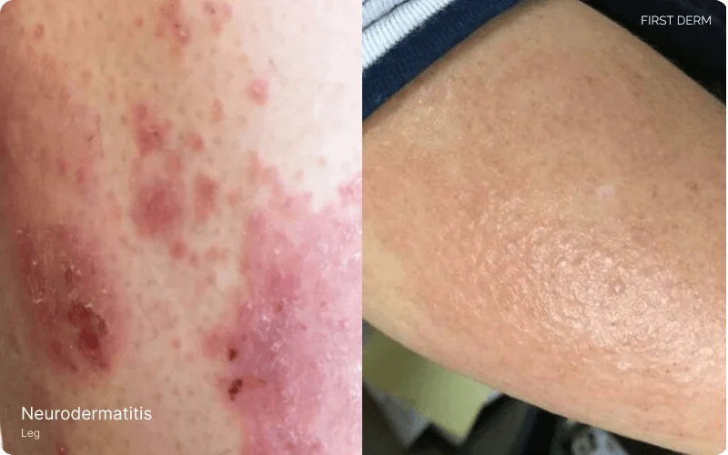 A close-up image exhibiting Neurodermatitis | Left: characterized by rough, leathery patches of skin that are intensely itchy. Right: reddish patch of skin on the leg in the primary stages of Neurodermatitis