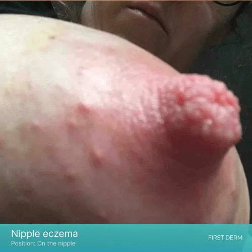 A close-up of a nipple and areola showing signs of eczema