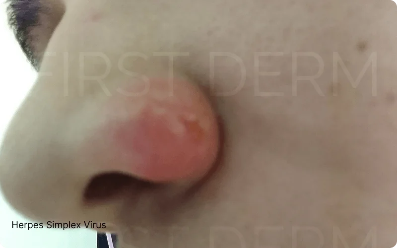 Close-up image of a cluster of small, non-itchy skin bumps appearing as blisters on the nose, surrounded by red inflamed skin, indicative of a Herpes Simplex infection. The condition is caused by Herpes Simplex Virus (HSV) type 1 or 2
