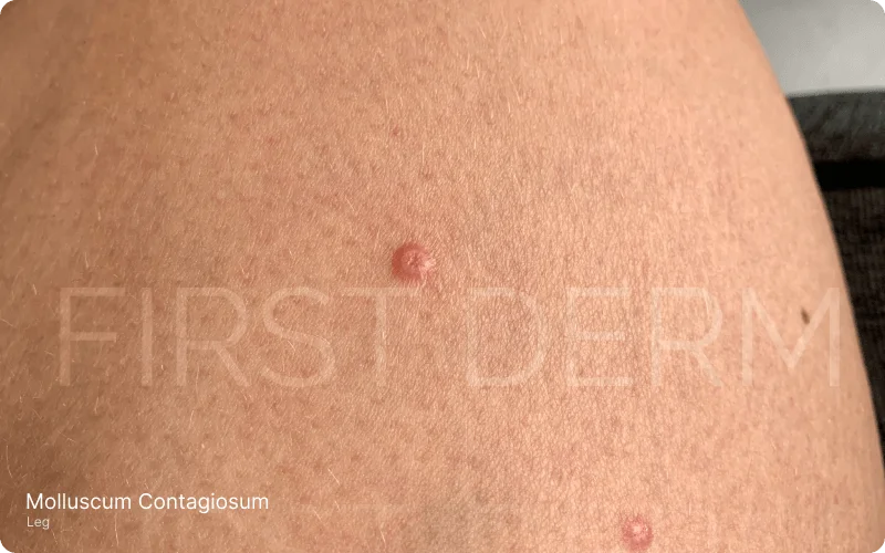 Close-up image of a thigh showing small, shiny, non-itchy skin bumps known as papules, characteristic of Molluscum Contagiosum. Each bump features a small indentation in the middle, indicative of this benign but contagious skin condition caused by a poxvirus.