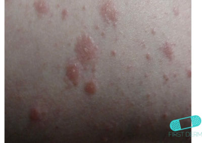 Nummular Eczema (Discoid Dermatitis) (13) skin [ICD-10 L30.0]