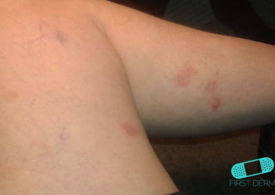Nummular Eczema leg (Discoid Dermatitis) (15) leg [ICD-10 L30.0]