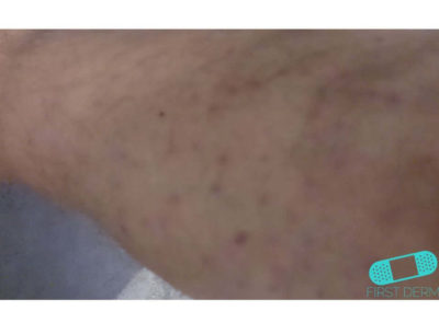 Nummular Eczema (Discoid Dermatitis) (16) skin [ICD-10 L30.0]
