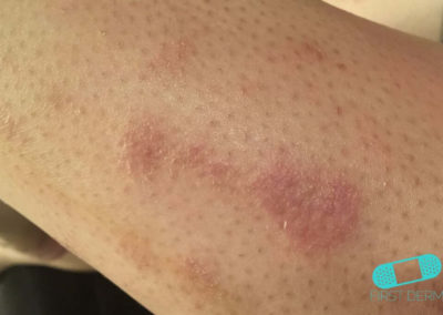 Nummular Eczema (Discoid Dermatitis) (18) leg [ICD-10 L30.0]