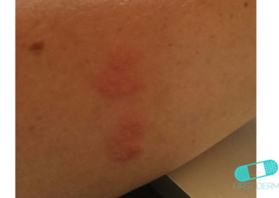 Nummular Eczema (Discoid Dermatitis) (19) skin [ICD-10 L30.0]