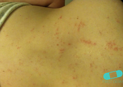 Nummular Eczema (Discoid Dermatitis) (20) skin ICD-10 L30.0]