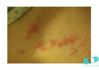 Nummular Eczema (Discoid Dermatitis) (21) skin [ICD-10 L30.0]