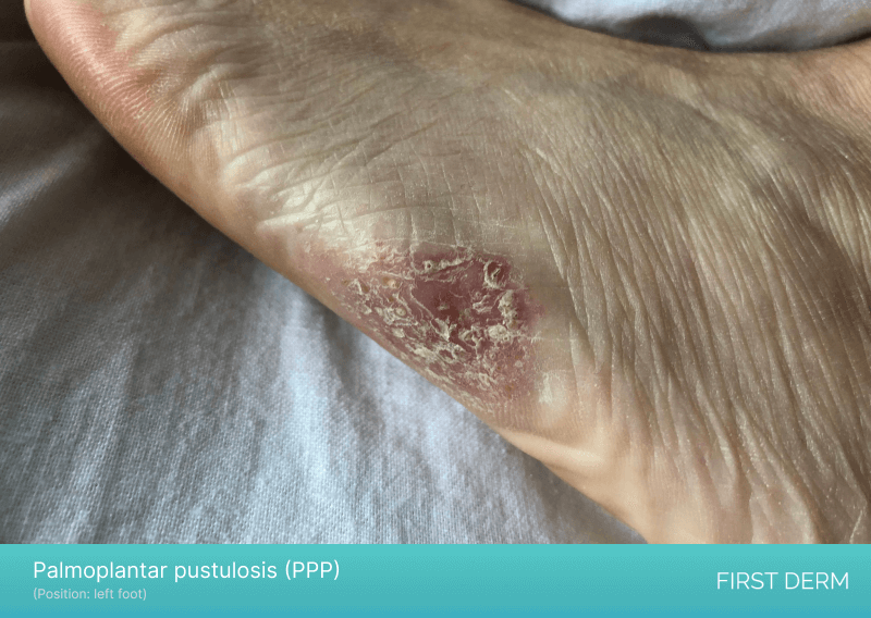 An image of Palmoplantar pustulosis (PPP) on a person's foot, displaying raised, pus-filled bumps and patches of red, inflamed skin on the side of the foot, characteristic of this chronic and debilitating skin condition