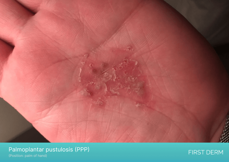 An image of Palmoplantar pustulosis (PPP) on a person's palm, showing raised, pus-filled bumps and patches of red, inflamed skin on the palm, characteristic of this chronic and debilitating skin condition