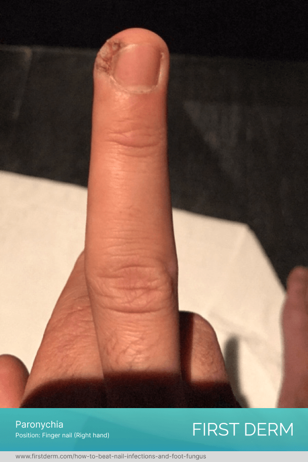 finger nail infected with Paronychia, a type of nail infection characterized by redness, swelling, and tenderness around the nail, visible as a red, swollen bump on the side of the nail