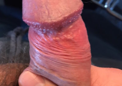 Pearly Penile Papules - Hirsuties coronae glandis - Penis ridge