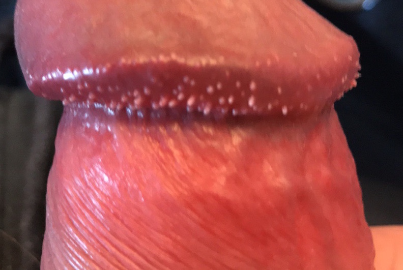 Pearly-Penile-Papules-Hirsuties-coronae-glandis-Penis-ridge-close-up