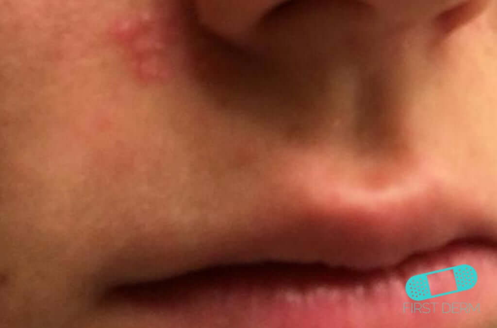 Perioral Dermatitis (03) nose [ICD-10 L71.0] close-up of the lower face, focusing on a single cluster of small red bumps located on the side of a nasal opening, illustrating a key manifestation of Perioral Dermatitis
