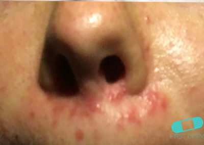 Perioral Dermatitis (07) nose [ICD-10 L71.0]