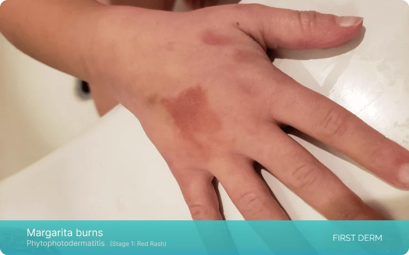 Close-up image of a hand displaying the initial stage of Margarita Dermatitis, also known as Margarita Burns, characterized by mild skin redness/ a subtle red rash