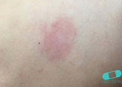 Pityriasis Rosea (03) herald patch [ICD-10 L42]