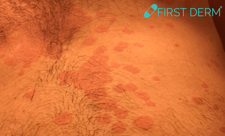 Cropped Pityriasis versicolor Skin Image Search AI