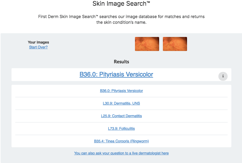 Pityriasis versicolor Skin Image Search AI_7